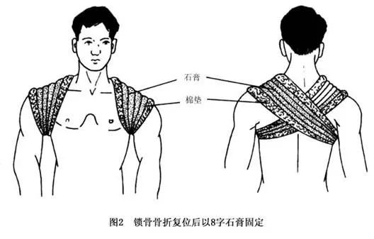 锁骨骨折两个月后的疼痛，原因、处理与预防