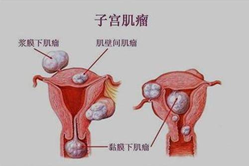 子宫肌瘤与广东省妇幼专家的专业解读