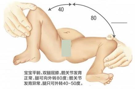 两个月宝宝腿纹不对称，原因、影响与应对措施