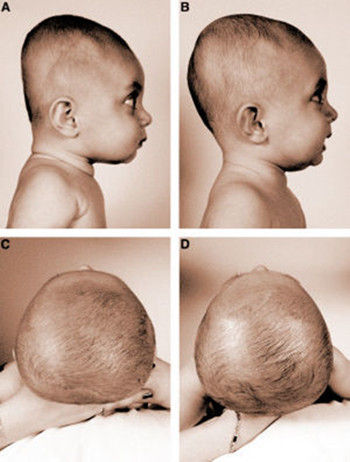 宝宝几个月可以睡头型——关于婴儿头型塑造的探讨